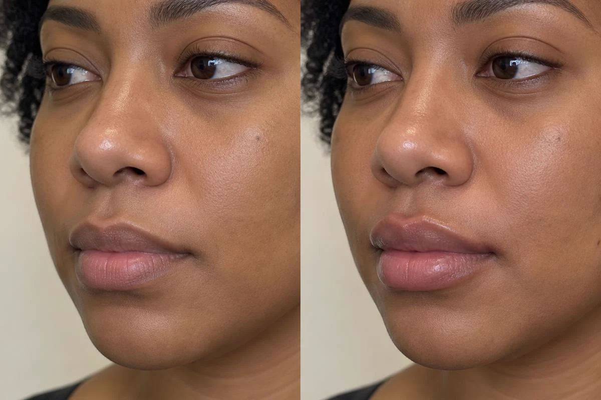 Illustrative before and after lip filler result on a younger adult with dark skin