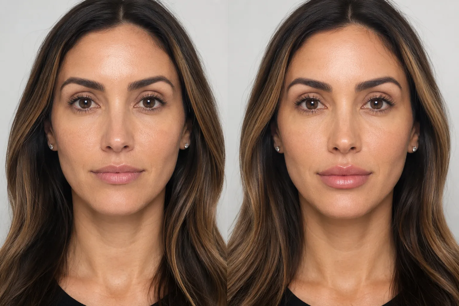 Before and after lip and dermal filler adding definition and volume